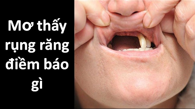Giải mã ý nghĩa giấc mơ rụng răng Giải mã ý nghĩa giấc mơ rụng răng